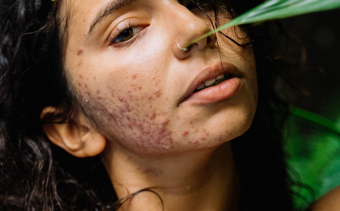 Top tips for looking after acne-prone skin